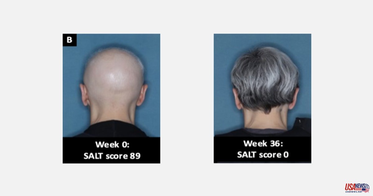 FDA approves the first treatment for alopecia that causes sudden hair loss