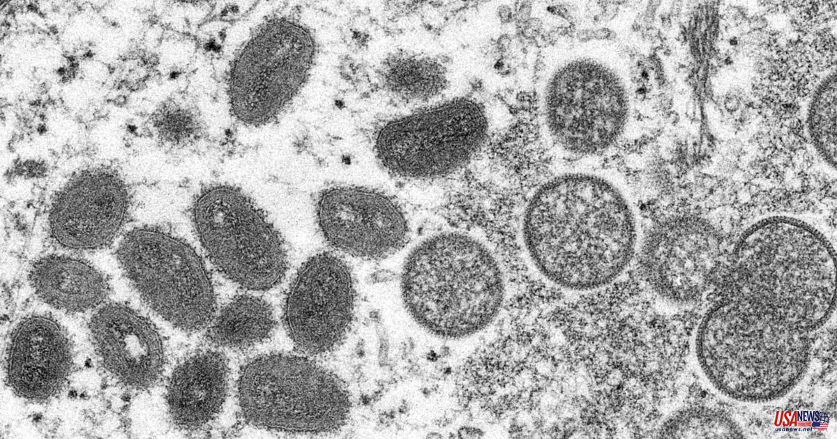 CDC states that monkeypox symptoms are different in recent cases than they were in the past