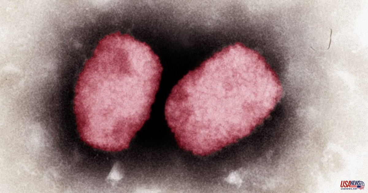 U.S. military service member in Germany becomes the first case of monkeypox.