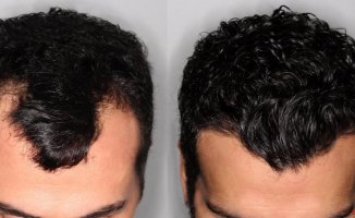 The latest advance in hair transplantation avoids the total shaving of the head