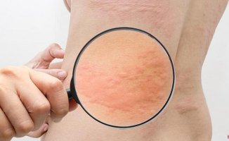What is hives? | Symptoms, causes and how to treat the disease