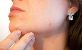 The best active ingredients to say goodbye to acne marks