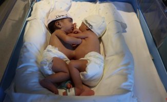 Two conjoined sisters arrive in Barcelona to be separated
