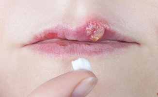 What is labial herpes? | Symptoms, causes and how to treat the disease