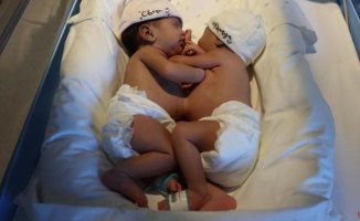 Two conjoined sisters successfully separated in Barcelona