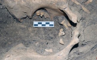 The strange ovarian tumor from 3,000 years ago in Egypt with two hooked teeth