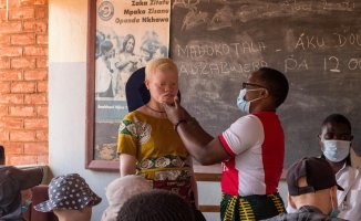 Albinos in Africa, persecuted citizens