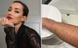 Adara returns to Instagram and shows the state of her burns after her doctor's accusation of false testimony